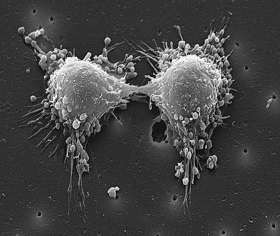 Cancer Cell Division Photograph By Steve Gschmeissner science Photo Library